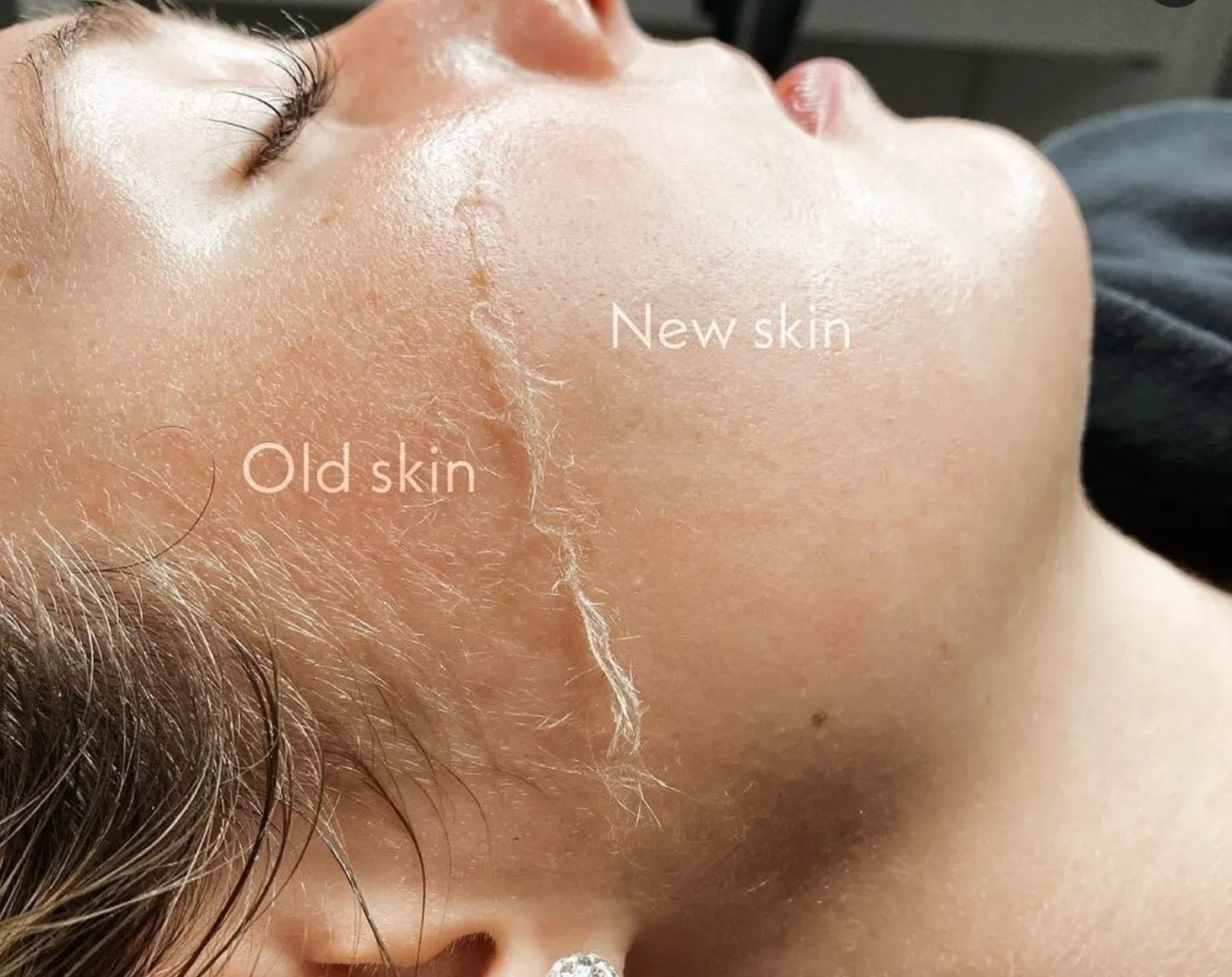 Melle Dermaplaner 1.0 rakblad 5-pack enkelblad